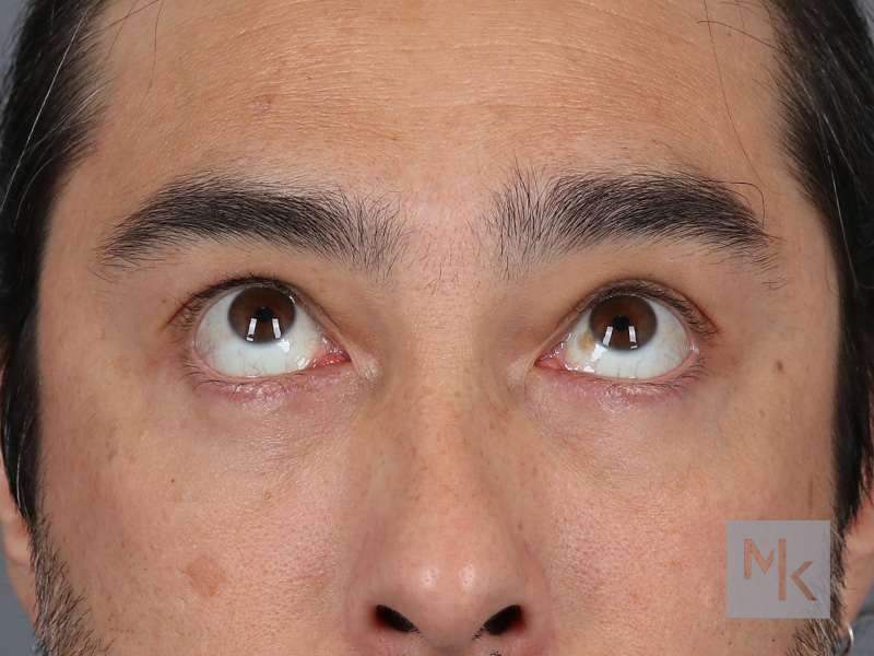 Lower Blepharoplasty Before and After | Dr. Michael Kim