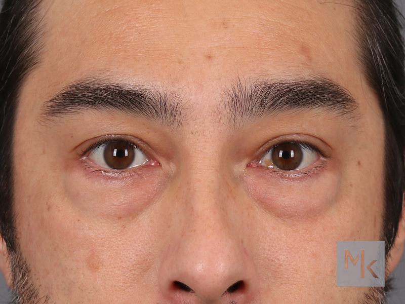 Lower Blepharoplasty Before and After | Dr. Michael Kim