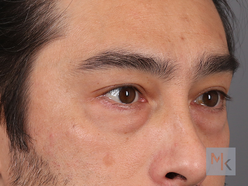 Lower Blepharoplasty Before and After | Dr. Michael Kim