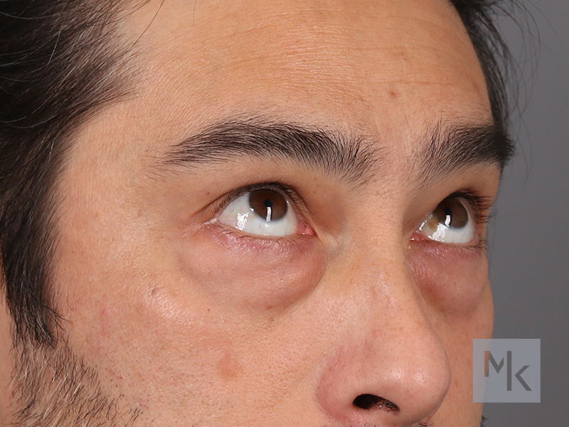 Lower Blepharoplasty Before and After | Dr. Michael Kim