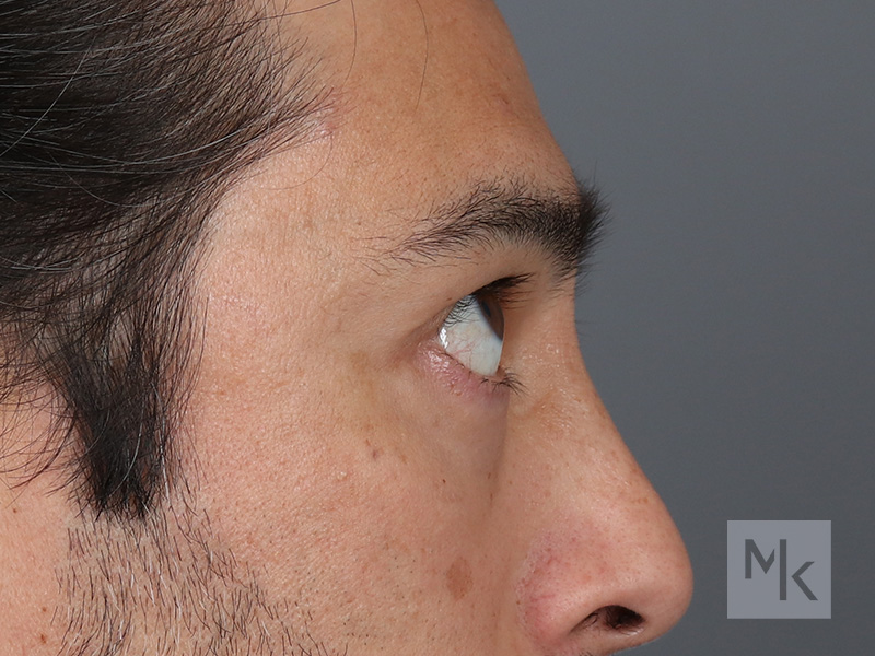 Lower Blepharoplasty Before and After | Dr. Michael Kim