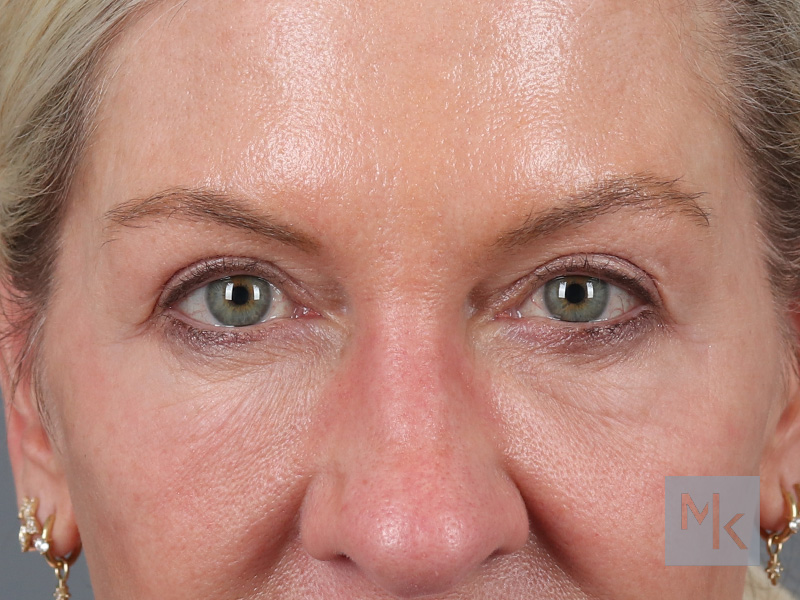 Lower Blepharoplasty Before and After | Dr. Michael Kim