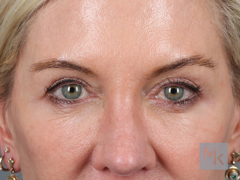 Lower Blepharoplasty Before and After | Dr. Michael Kim