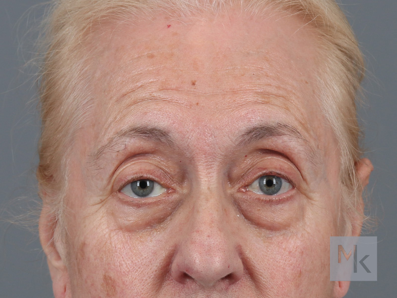 Lower Blepharoplasty Before and After | Dr. Michael Kim