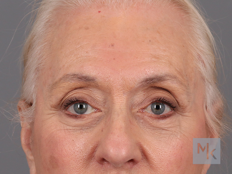 Lower Blepharoplasty Before and After | Dr. Michael Kim