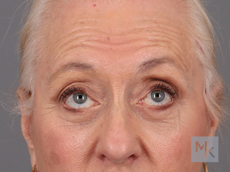 Lower Blepharoplasty Before and After | Dr. Michael Kim