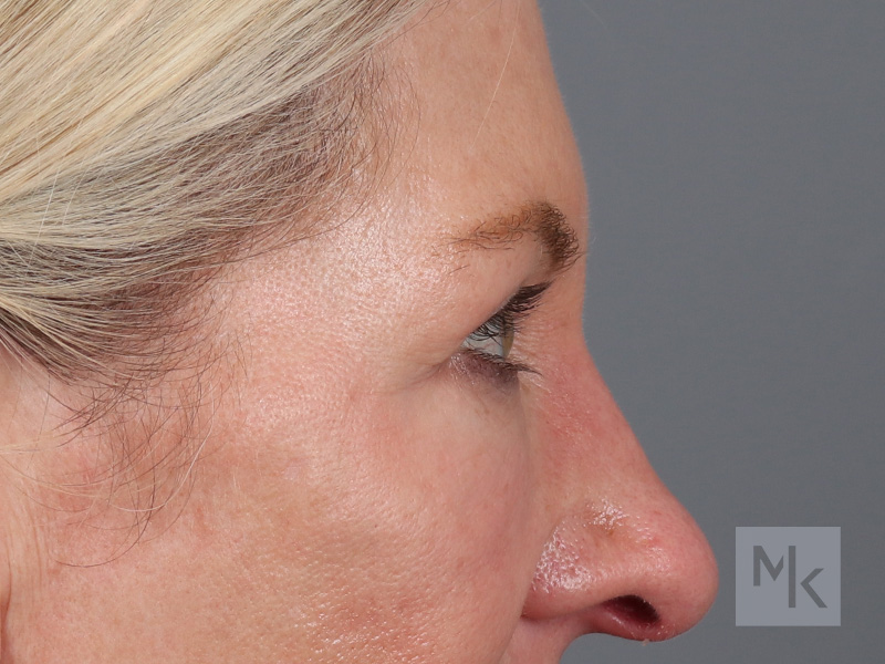 Lower Blepharoplasty Before and After | Dr. Michael Kim