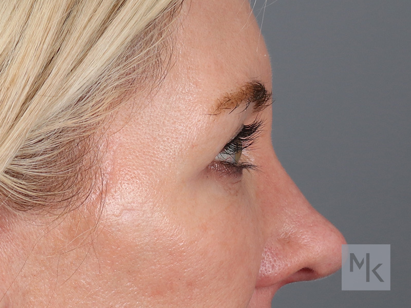 Lower Blepharoplasty Before and After | Dr. Michael Kim