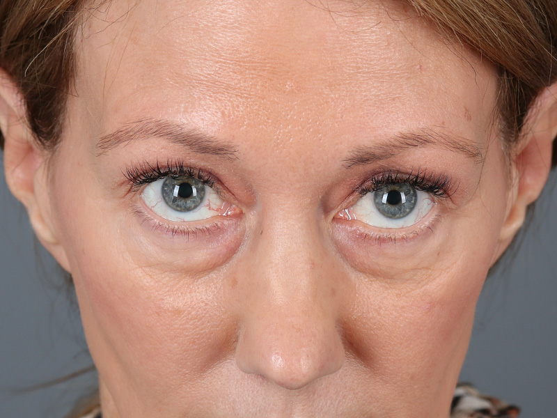 Lower Blepharoplasty Before and After | Dr. Michael Kim