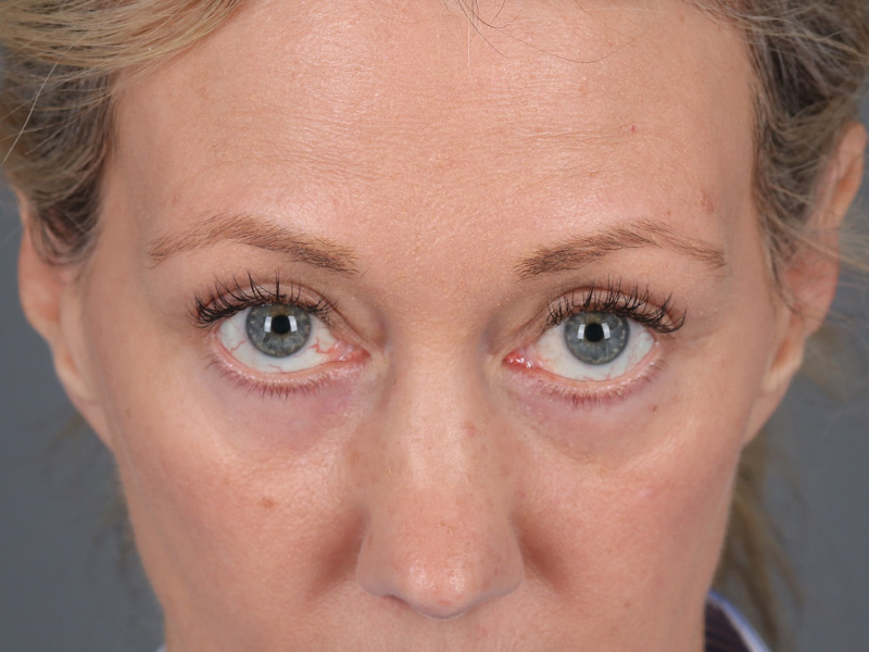 Lower Blepharoplasty Before and After | Dr. Michael Kim