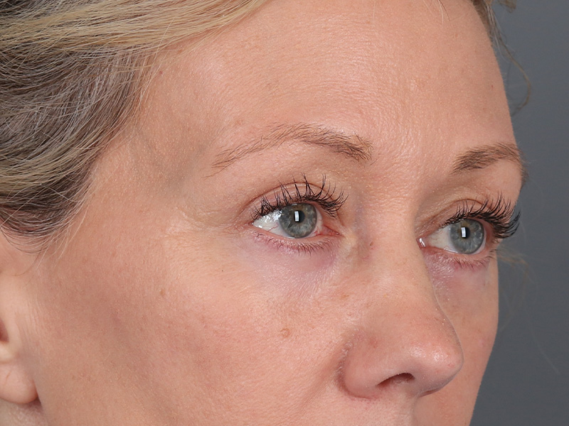 Lower Blepharoplasty Before and After | Dr. Michael Kim