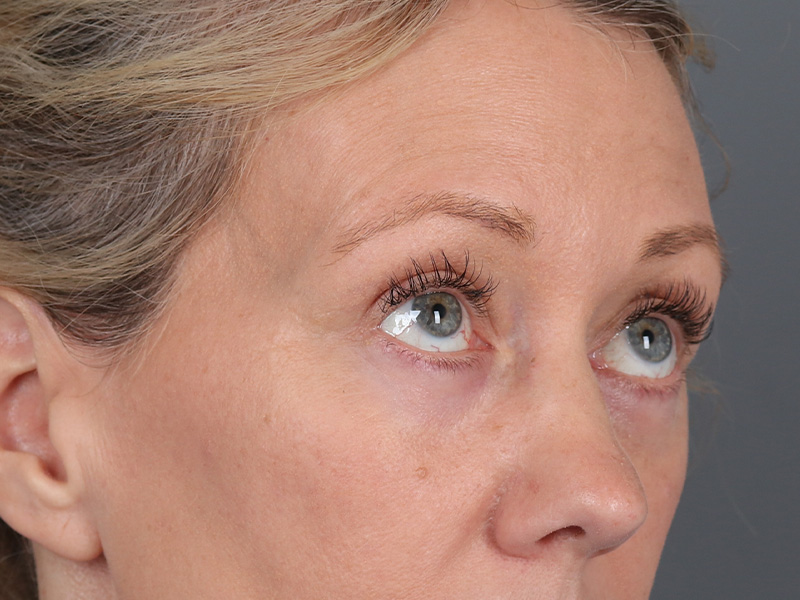 Lower Blepharoplasty Before and After | Dr. Michael Kim