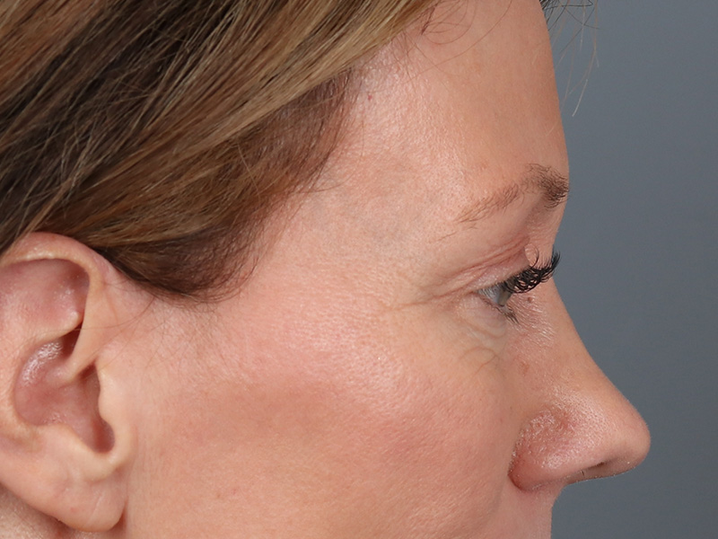 Lower Blepharoplasty Before and After | Dr. Michael Kim