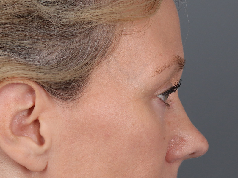 Lower Blepharoplasty Before and After | Dr. Michael Kim