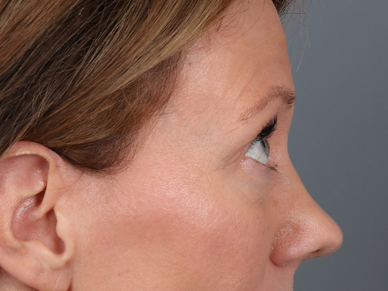Lower Blepharoplasty Before and After | Dr. Michael Kim