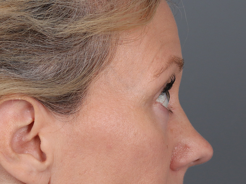 Lower Blepharoplasty Before and After | Dr. Michael Kim