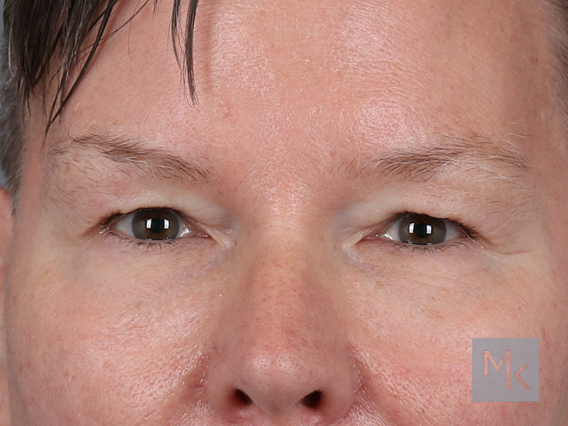 Lower Blepharoplasty Before and After | Dr. Michael Kim