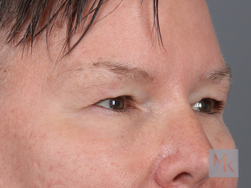 Lower Blepharoplasty Before and After | Dr. Michael Kim