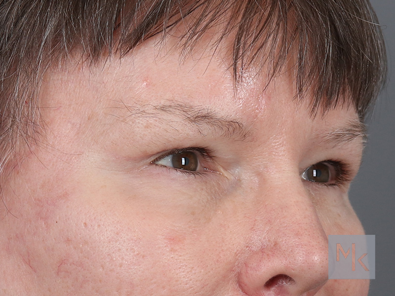 Lower Blepharoplasty Before and After | Dr. Michael Kim