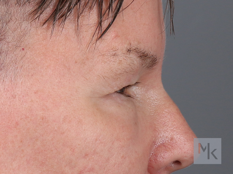 Lower Blepharoplasty Before and After | Dr. Michael Kim
