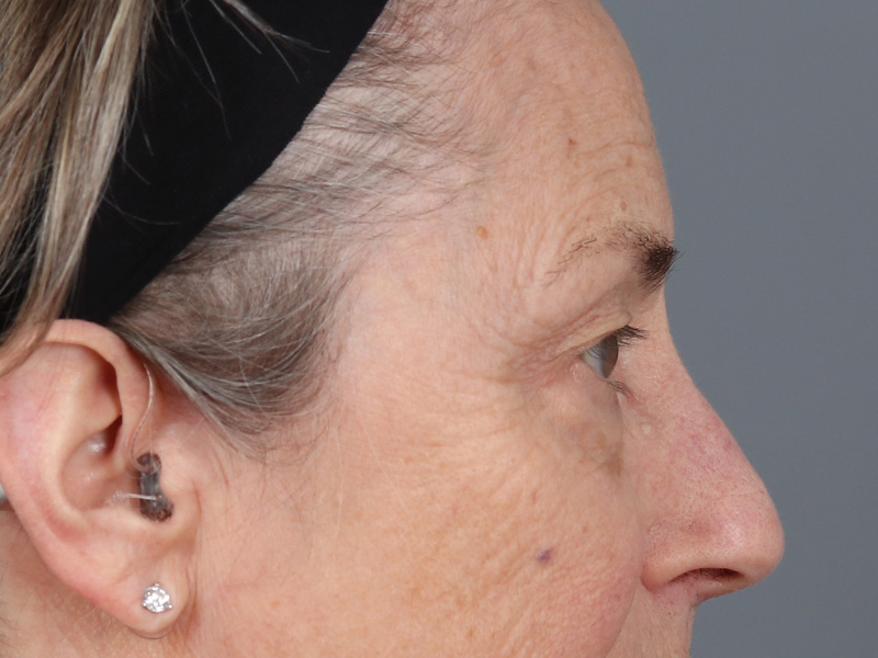 Lower Blepharoplasty Before and After | Dr. Michael Kim