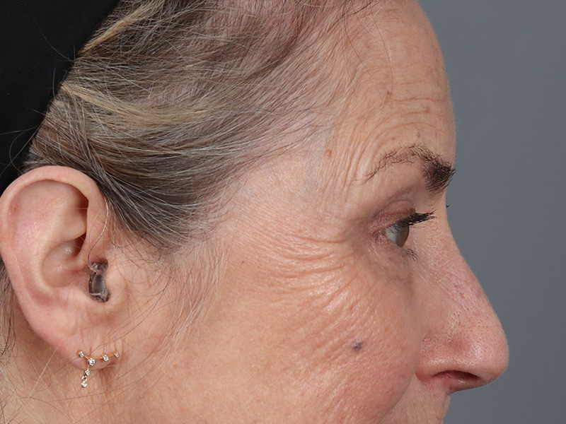 Lower Blepharoplasty Before and After | Dr. Michael Kim
