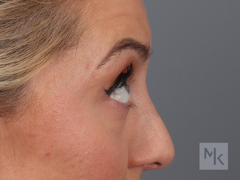 Lower Blepharoplasty Before and After | Dr. Michael Kim