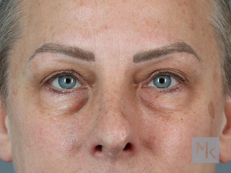 Lower Blepharoplasty Before and After | Dr. Michael Kim