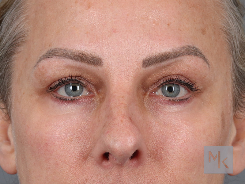 Lower Blepharoplasty Before and After | Dr. Michael Kim