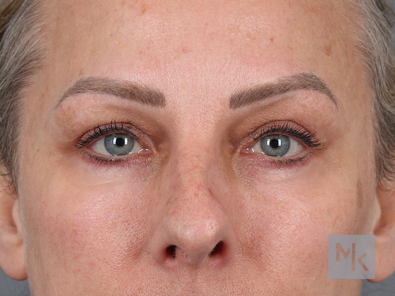 Lower Blepharoplasty Before and After | Dr. Michael Kim