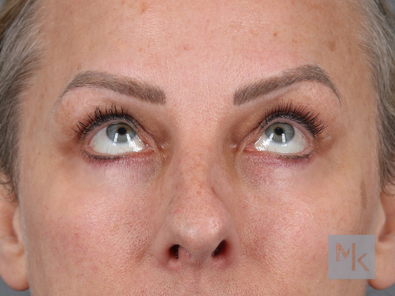 Lower Blepharoplasty Before and After | Dr. Michael Kim