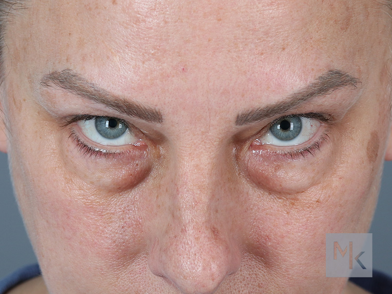 Lower Blepharoplasty Before and After | Dr. Michael Kim