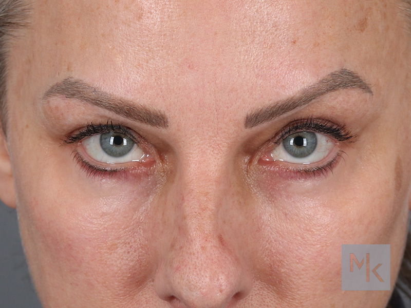 Lower Blepharoplasty Before and After | Dr. Michael Kim