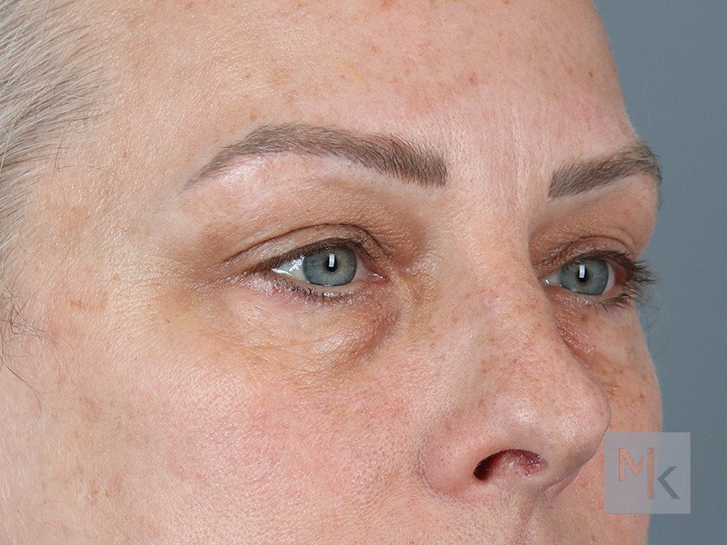 Lower Blepharoplasty Before and After | Dr. Michael Kim