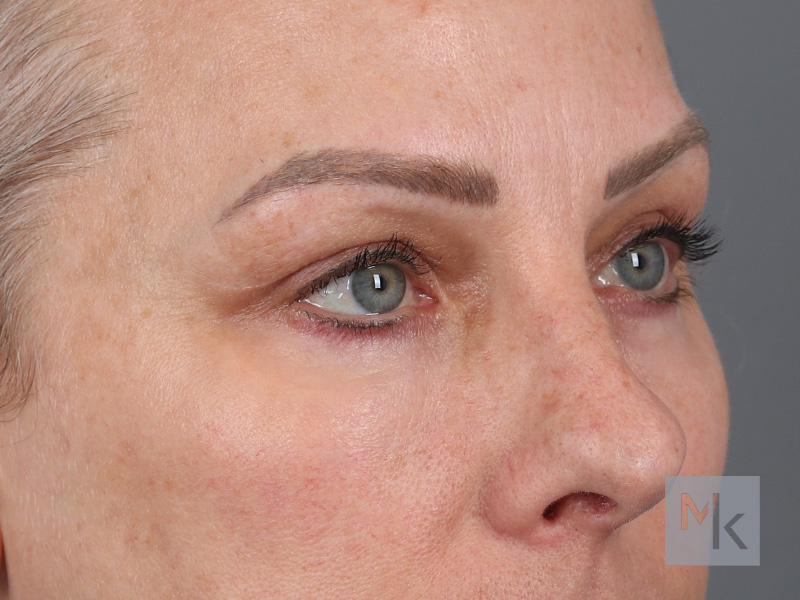 Lower Blepharoplasty Before and After | Dr. Michael Kim