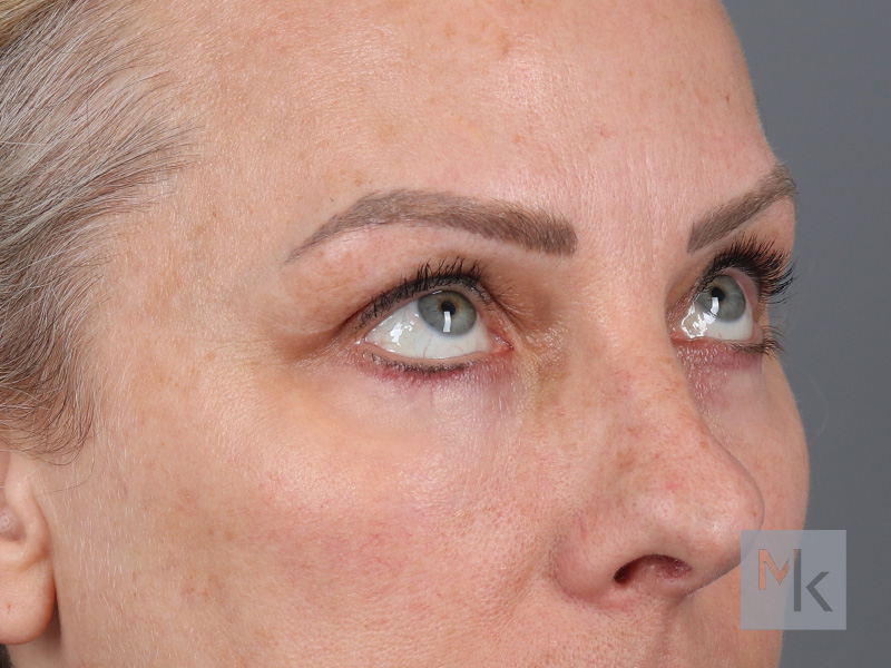 Lower Blepharoplasty Before and After | Dr. Michael Kim