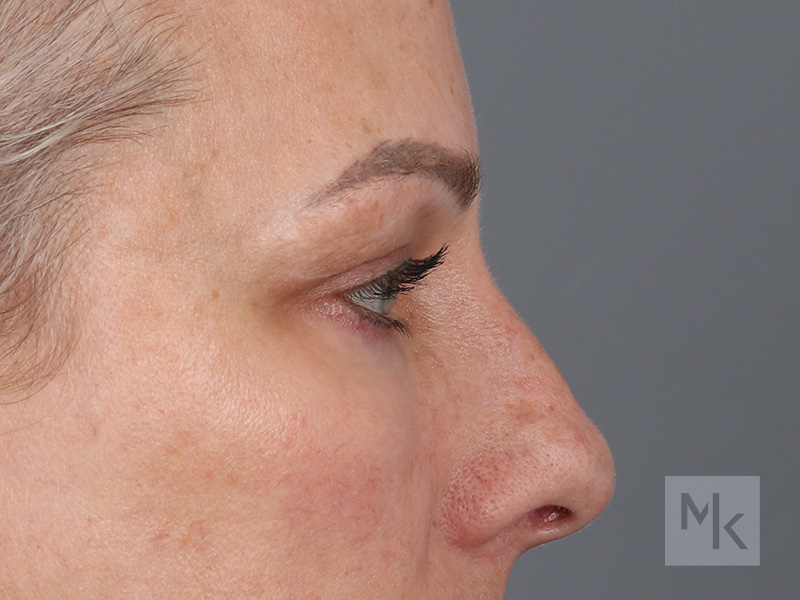 Lower Blepharoplasty Before and After | Dr. Michael Kim