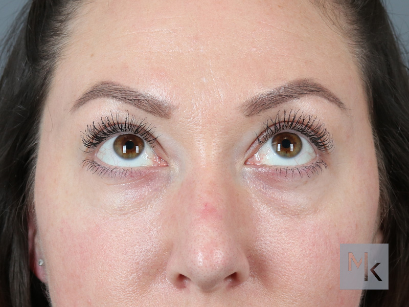 Lower Blepharoplasty Before and After | Dr. Michael Kim