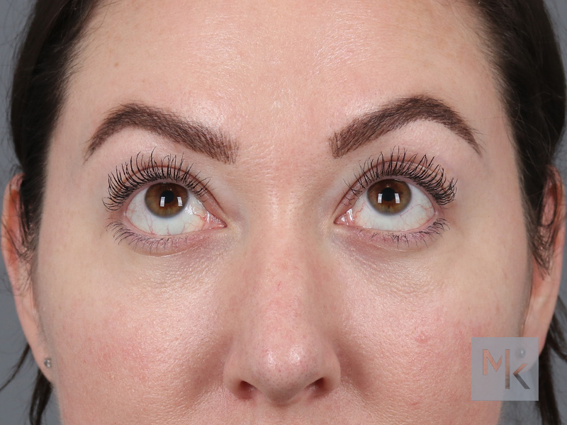 Lower Blepharoplasty Before and After | Dr. Michael Kim