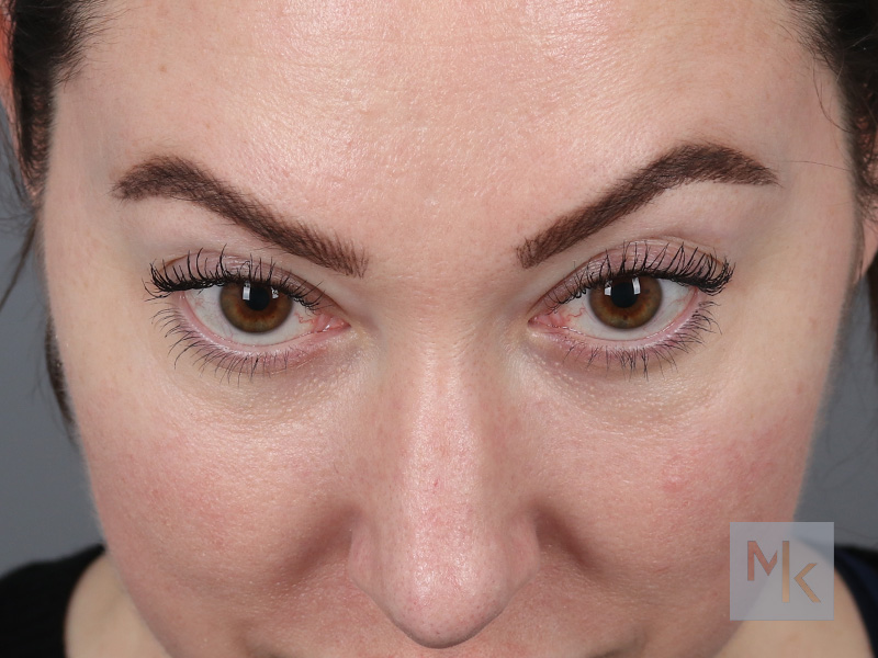 Lower Blepharoplasty Before and After | Dr. Michael Kim