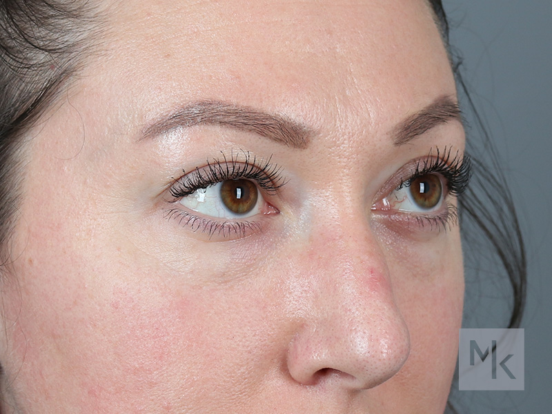 Lower Blepharoplasty Before and After | Dr. Michael Kim