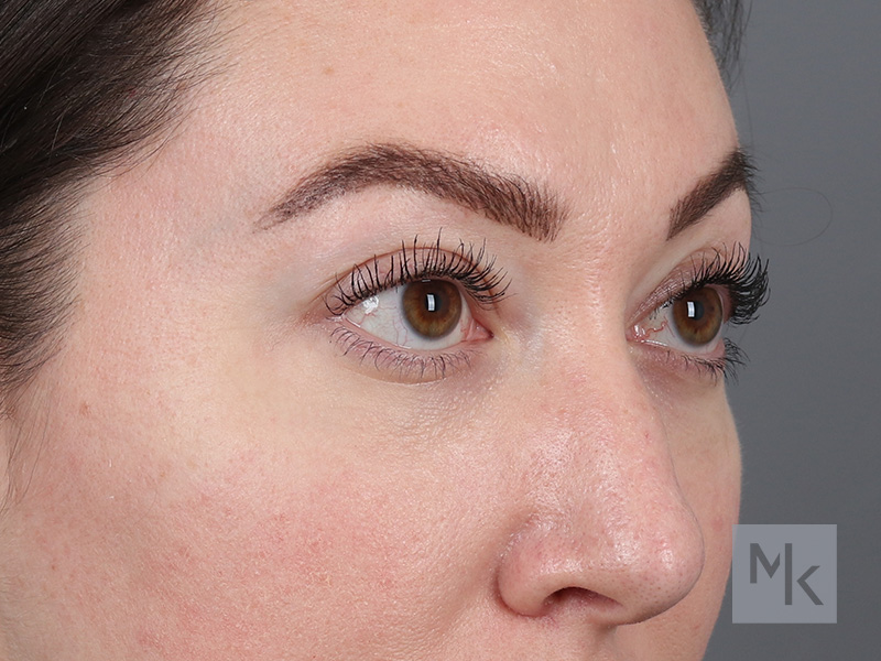 Lower Blepharoplasty Before and After | Dr. Michael Kim