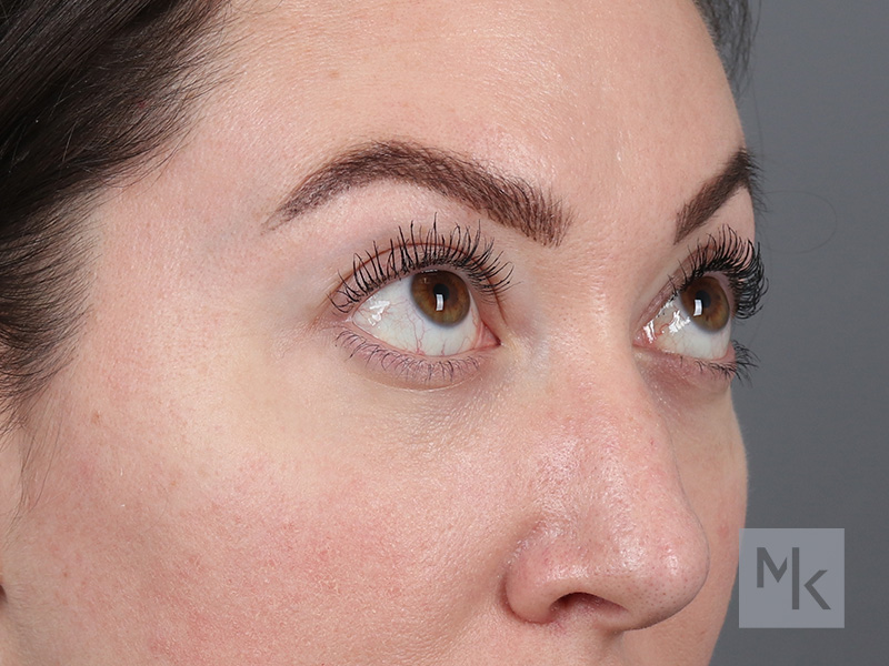 Lower Blepharoplasty Before and After | Dr. Michael Kim