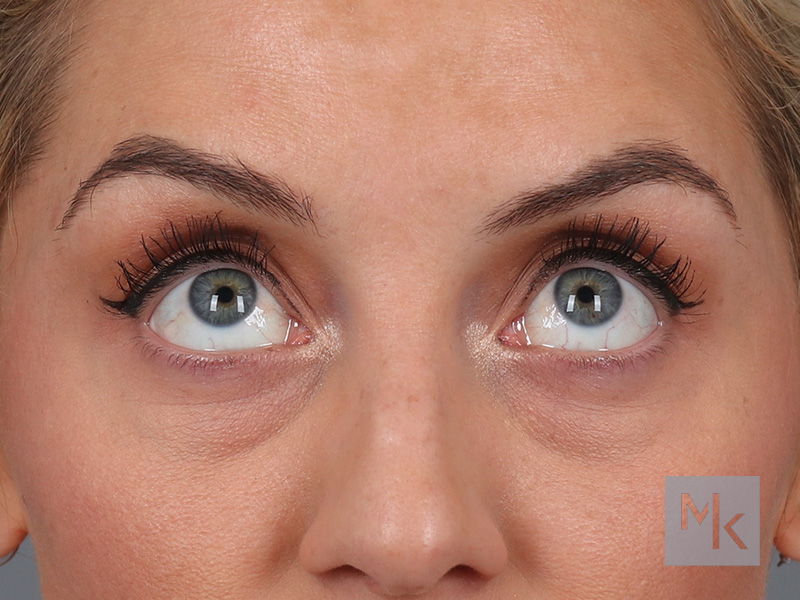 Lower Blepharoplasty Before and After | Dr. Michael Kim