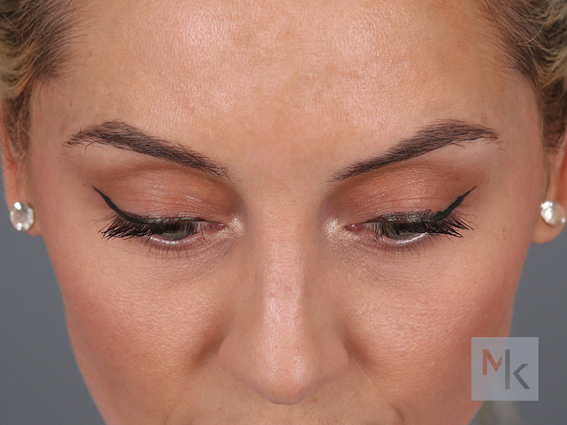 Lower Blepharoplasty Before and After | Dr. Michael Kim