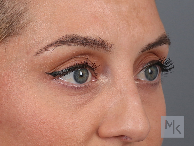 Lower Blepharoplasty Before and After | Dr. Michael Kim