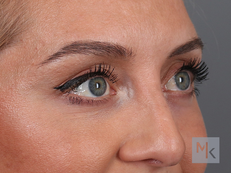 Lower Blepharoplasty Before and After | Dr. Michael Kim