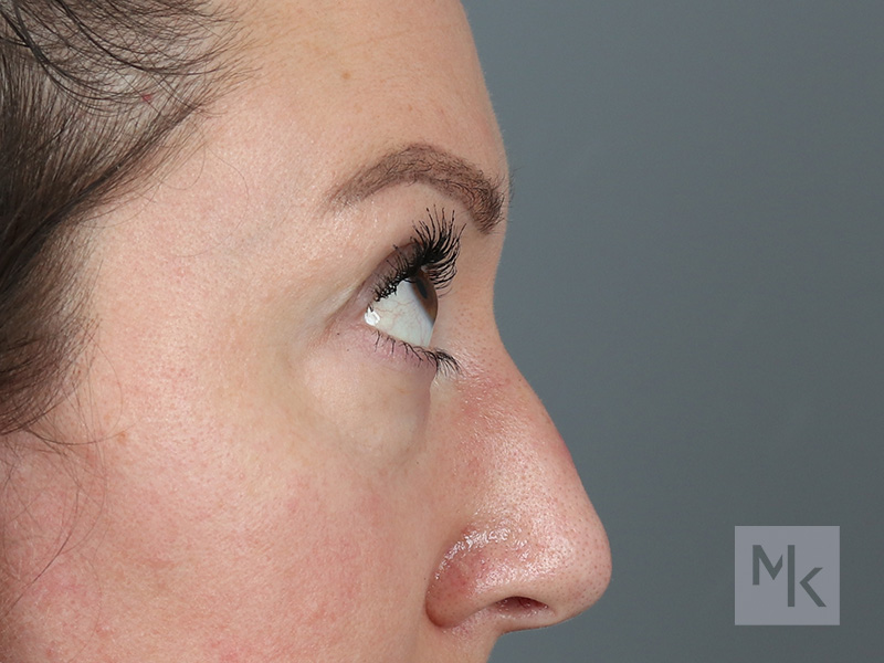 Lower Blepharoplasty Before and After | Dr. Michael Kim