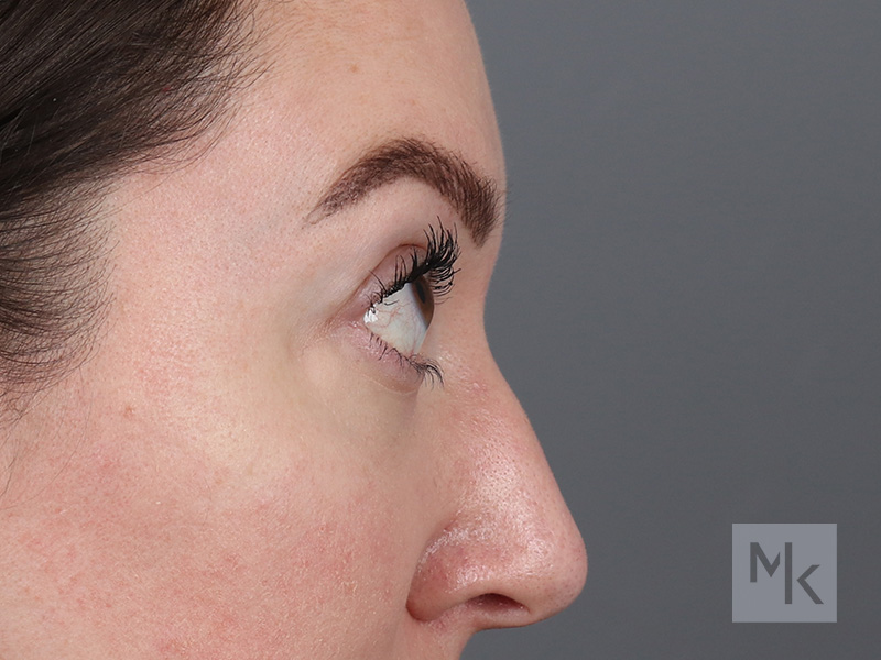 Lower Blepharoplasty Before and After | Dr. Michael Kim