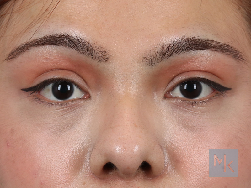Lower Blepharoplasty Before and After | Dr. Michael Kim